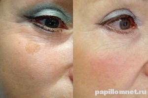 До и после лечения пигментных пятен на лице