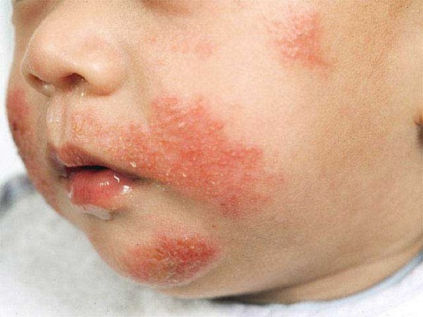 Пищевая аллергия у ребёнка