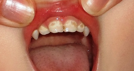 Пятна на зубах у ребенка: причины появления