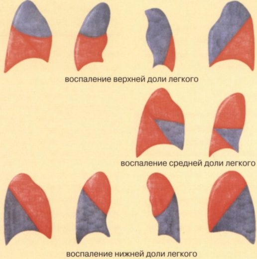 различные типы пневмонии