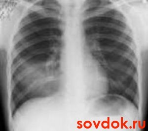 пневмония на рентгене