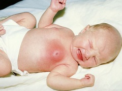 Почему у новорожденного увеличены молочные железы?