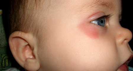 У ребенка красно под глазами: возможные причины