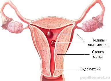 Фото матки со схемой расположения полипа эндометрия