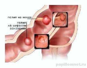 Схематичное изображение расположения полипов в кишечнике