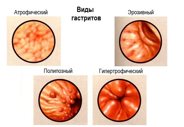 Виды заболевания