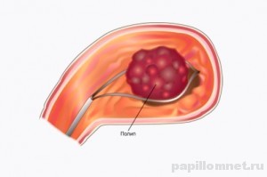 Схема удаления полипа в желудке