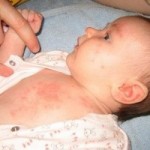 Потница у ребенка: фото, симптомы и лечение