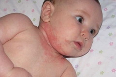 Симптомы аллергии у детей