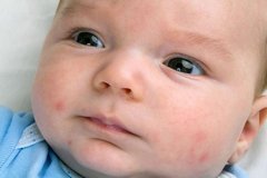 Проблемы кожи лица новорожденного