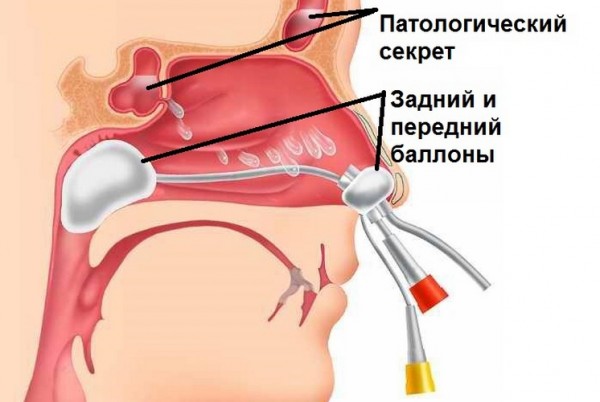 Процедура откачивания гноя из придаточных пазух носа при помощи ямик-катетера