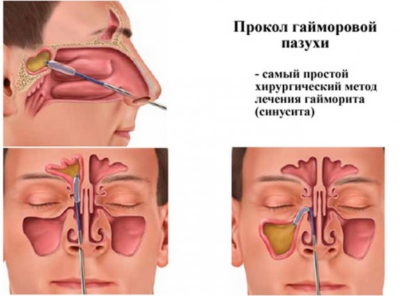 Пункция придаточных пазух носа