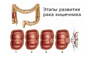 Рак подвздошной кишки