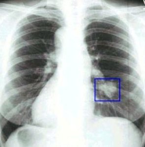Фотография рентгена рака легких