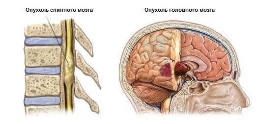 Симптомы рака спинного мозга