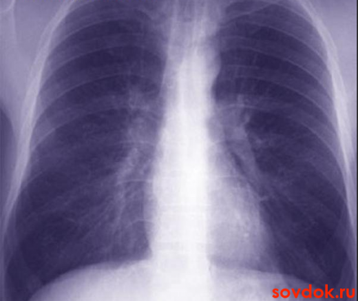 рентген лёгких