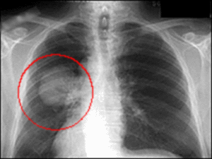 Рентген снимок при раке легких
