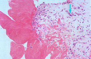 Ревматический эндокардит под микроскопом