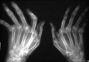 Ревматоидный артрит на рентгеном снимке