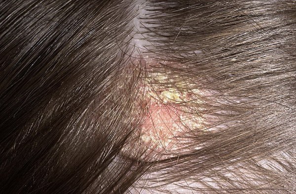 себорейный дерматит кожи головы