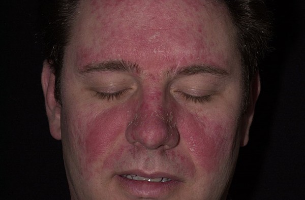 лечение себорейного дерматита на лице