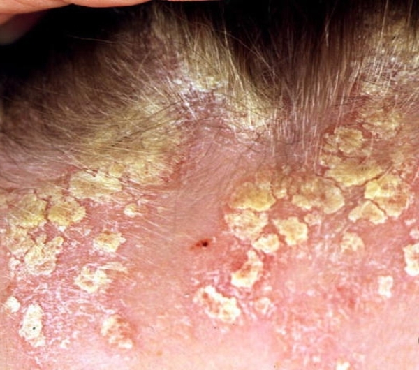 причины себорейного дерматита на лице