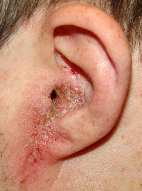 симптомы себорейного дерматита на лице