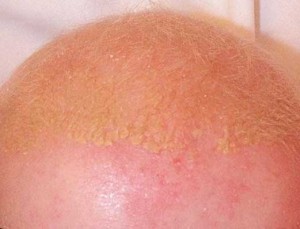 Себорейный дерматит у младенца на голове