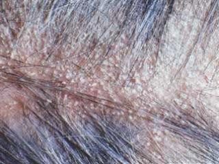 Себорейный дерматит волосистой части головы фото