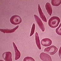 Серповидно-клеточная анемия. Симптомы и лечение