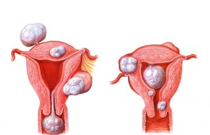 Схематичное изображение фибром на теле матки