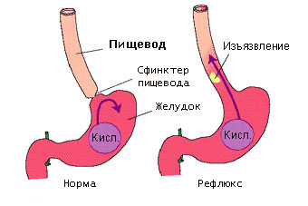 Схема развития эзофагита