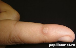 Фото пальца с проявлением ВПЧ в виде шипицы