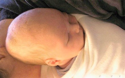 Мягкая шишка на голове у новорожденного