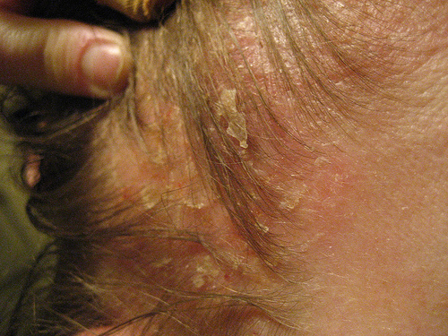 симптомы себорейного дерматита на голове