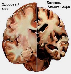Как проявляется синдром Альцгеймера