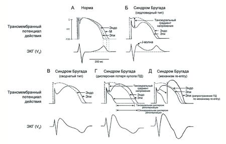 Сопоставление ПД в стенке правого желудочка и ЭКГ в норме и при синдроме Бругада 