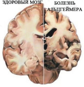 Сравнение мозга здорового человека и пациента с заболеванием Альцгеймера