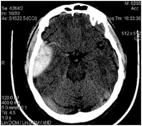 томография головного мозга