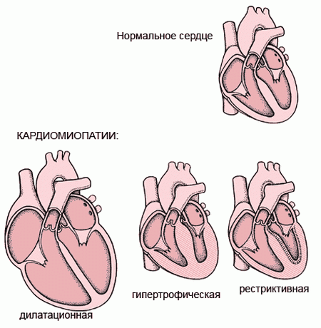 В течении алкогольного поражения сердца выделяют 3 стадии