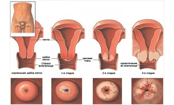 Четыре стадии рака шейки матки