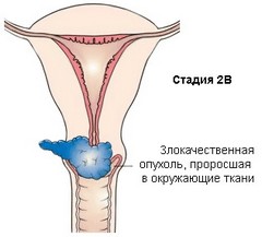 2 стадия рака шейки матки