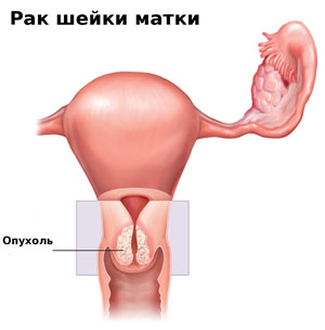 Какие бывают стадии рака шейки матки