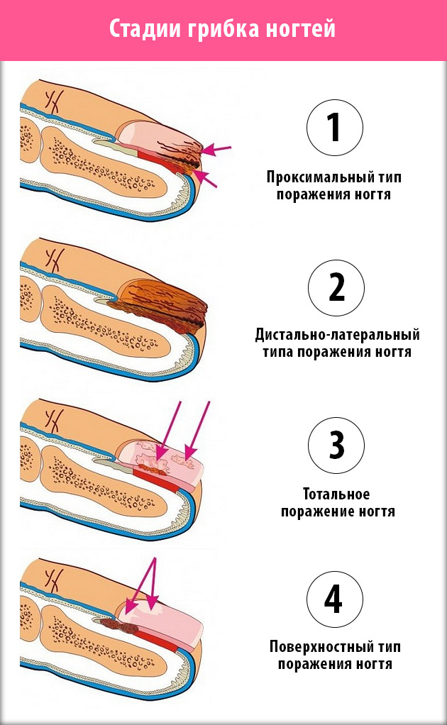 Стадии развития грибка ногтей 