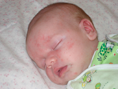 Причины стафилококка у новорожденных