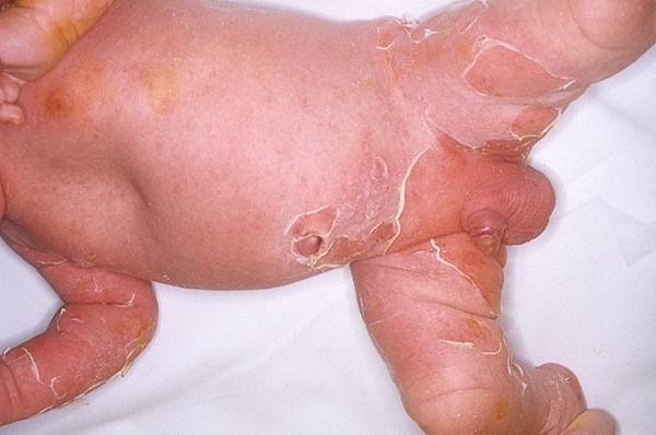 стафилококковый дерматит у детей