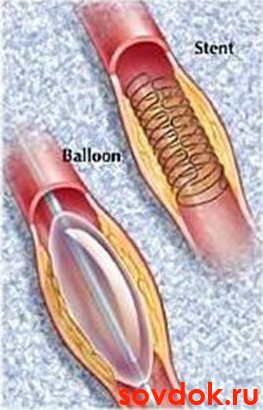 стенты и балоны в сосудах