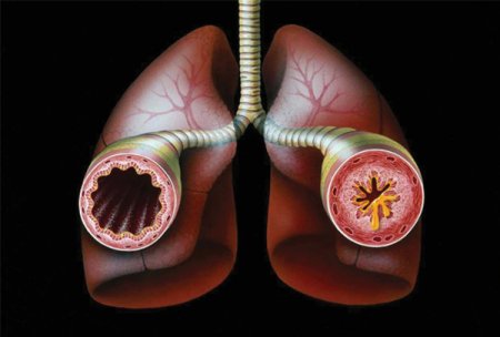 Экзогенная бронхиальная астма