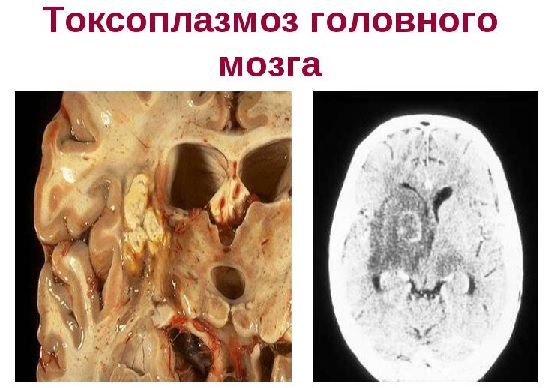 Токсоплазмоз головного мозга  