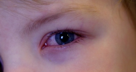 Почему у ребенка красные глаза: возможные причины